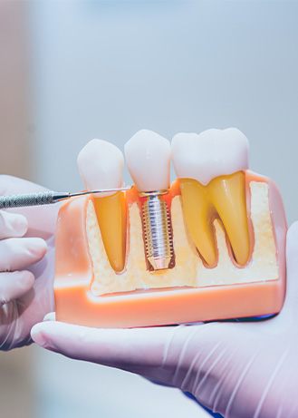 a close-up of a model of dental implants