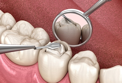 Illustration of resin applied to cavity