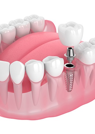 Illustration of a single dental implant