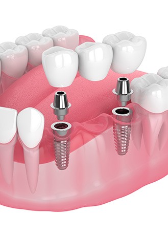 Illustration of an implant bridge