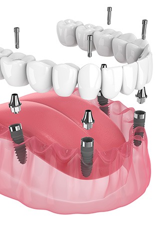 Illustration of an implant denture