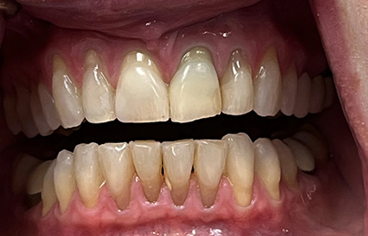 Close up of a patient's straight teeth after Invisalign treatment