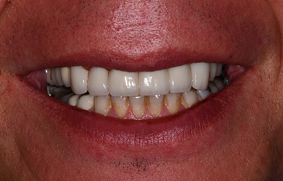 Mouth after restoring worn down teeth with dental crowns