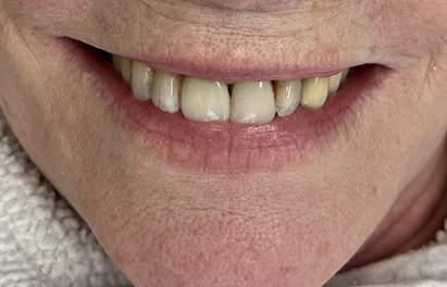 Smile with a full row of even upper front teeth