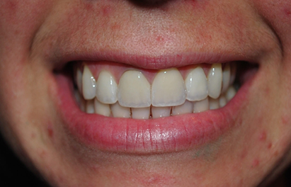 Smile after addressing chipped and discolored front teeth with veneers