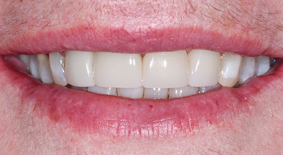 Smile after treating discolored and stubby front teeth with dental crowns