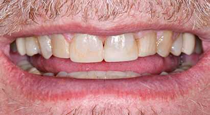 Smile after restoring a chipped front tooth
