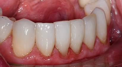 Row of teeth after treating small black triangles
