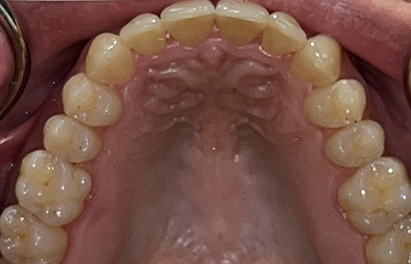 Upper arch of straightened teeth