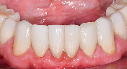 Arch of teeth after treating small black triangles