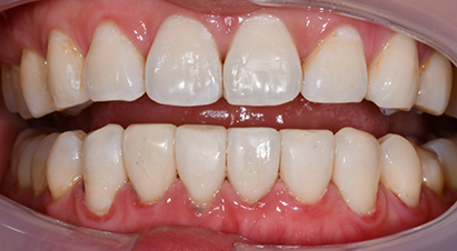 Smile after correcting a few black triangles between the teeth