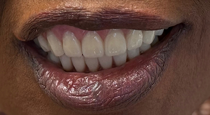 Smile with a full set of flawless, natural looking teeth