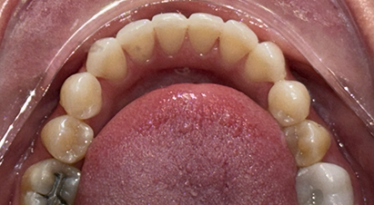Lower arch of straightened teeth