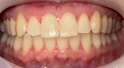 Close up of closed teeth that are properly aligned