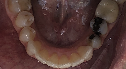 Lower arch of teeth after correcting overlapping teeth