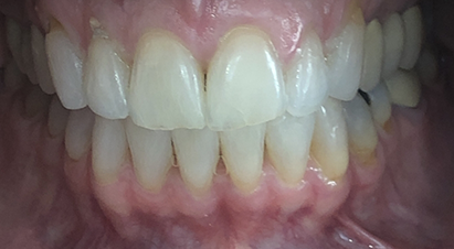 Mouth after correcting slightly rotated teeth