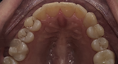 Upper arch of teeth after correcting overlapping teeth