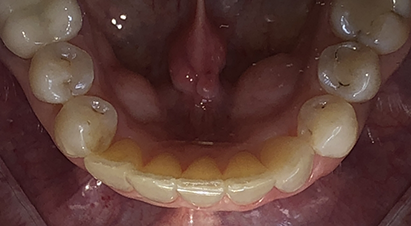 Arch of teeth after treating overcrowding and overlapping