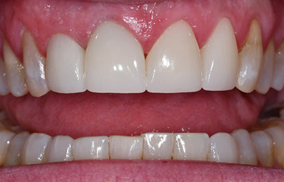 Mouth with evenly colored front teeth