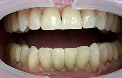 Smile after closing small black triangles between the lower front teeth