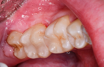 Close up of decayed teeth restored with white fillings