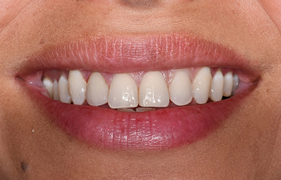 Smile after restoring a gray stained tooth with a dental crown