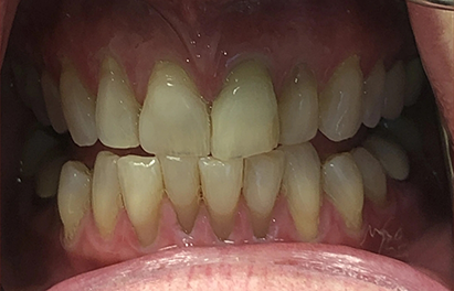 Close up of a patient's crooked teeth before Invisalign treatment