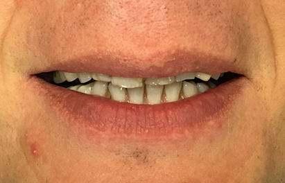 Mouth with several worn down teeth