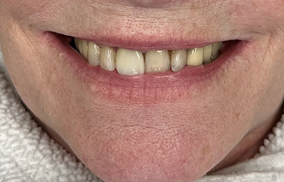Smile with a slightly uneven upper front tooth