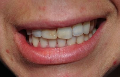 Smile with chipped and discolored front teeth