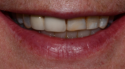 Smile with a few discolored and stubby front teeth