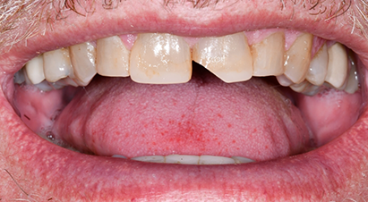 Smile with a severely chipped front tooth