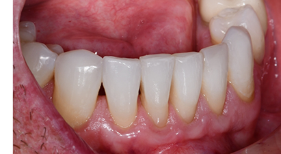 Row of teeth with small black triangles between a few teeth