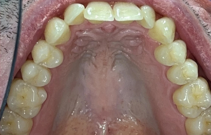 Upper arch of slightly misaligned teeth