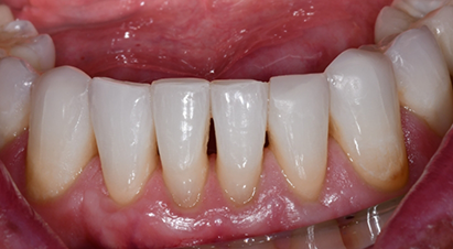 Arch of teeth with small black triangles between a few teeth