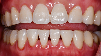 Smile with a few black triangles between the teeth