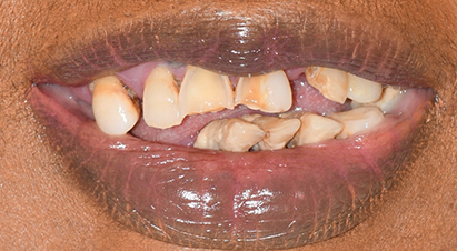 Smile with multiple missing, discolored, and damaged teeth