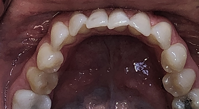 Lower arch of misaligned teeth