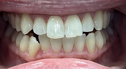 Close up of closed teeth with an open bite