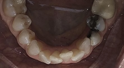Lower arch of teeth with some slightly overlapping teeth