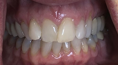 Mouth with a few slightly rotated teeth