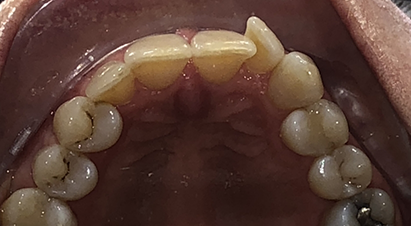 Upper arch of teeth with some slightly overlapping teeth