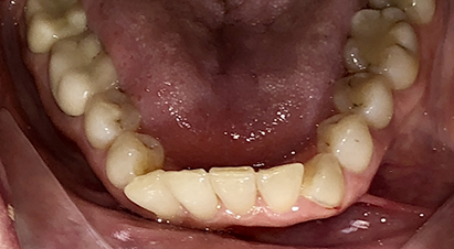 Arch of teeth with some overcrowding and overlapping