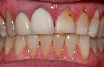 Mouth with several discolored front teeth