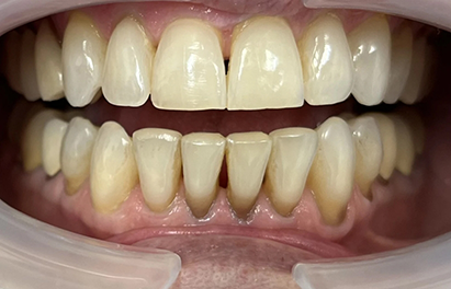 Smile with small black triangles between the lower front teeth
