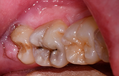 Close up of a few decayed teeth