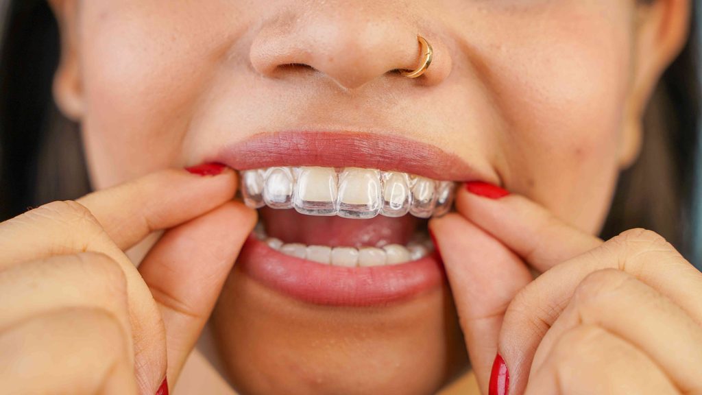 Woman with clear aligners
